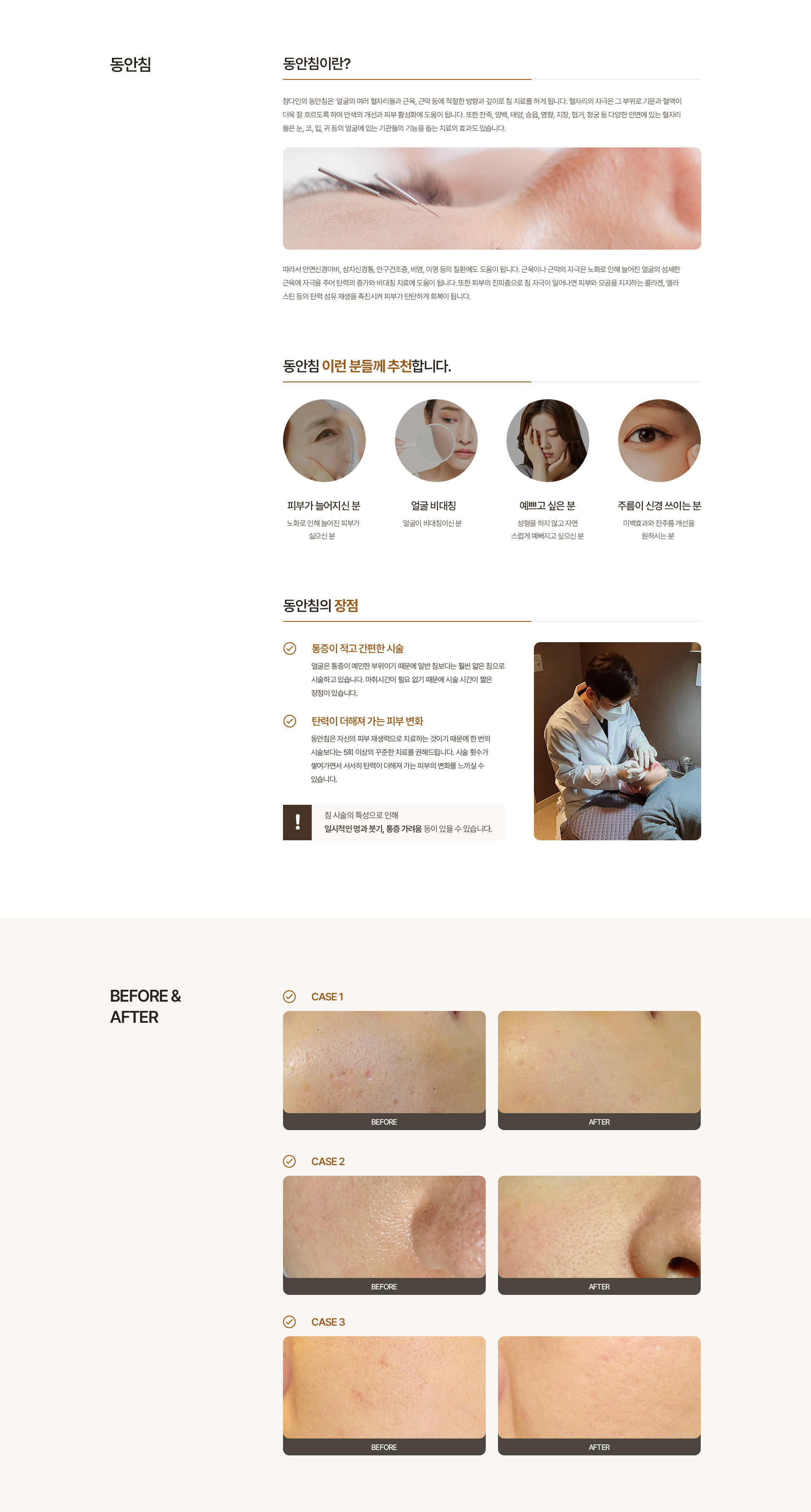 미세침, 청안침, 동안침 내용